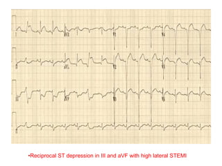 •Reciprocal ST depression in III and aVF with high lateral STEMI
 