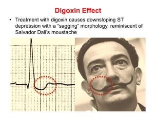 Digoxin Effect
• Treatment with digoxin causes downsloping ST
depression with a “sagging” morphology, reminiscent of
Salvador Dali’s moustache
 
