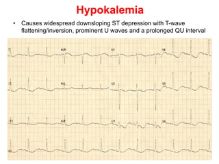 Hypokalemia
• Causes widespread downsloping ST depression with T-wave
flattening/inversion, prominent U waves and a prolonged QU interval
 