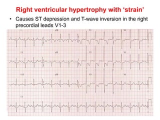 Right ventricular hypertrophy with ‘strain’
• Causes ST depression and T-wave inversion in the right
precordial leads V1-3
 