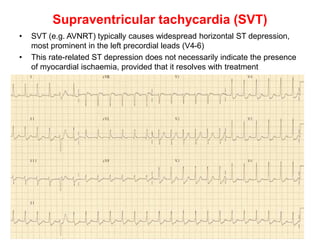 Supraventricular tachycardia (SVT)
• SVT (e.g. AVNRT) typically causes widespread horizontal ST depression,
most prominent in the left precordial leads (V4-6)
• This rate-related ST depression does not necessarily indicate the presence
of myocardial ischaemia, provided that it resolves with treatment
 