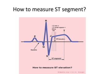 How to measure ST segment?
 
