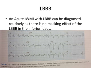 LBBB
• An Acute IWMI with LBBB can be diagnosed
routinely as there is no masking effect of the
LBBB in the inferior leads.
 