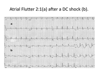 Atrial Flutter 2:1(a) after a DC shock (b).
 