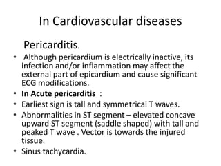 In Cardiovascular diseases
Pericarditis.
• Although pericardium is electrically inactive, its
infection and/or inflammation may affect the
external part of epicardium and cause significant
ECG modifications.
• In Acute pericarditis :
• Earliest sign is tall and symmetrical T waves.
• Abnormalities in ST segment – elevated concave
upward ST segment (saddle shaped) with tall and
peaked T wave . Vector is towards the injured
tissue.
• Sinus tachycardia.
 