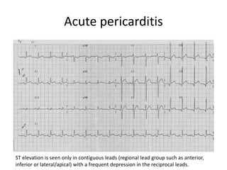 Acute pericarditis
ST elevation is seen only in contiguous leads (regional lead group such as anterior,
inferior or lateral/apical) with a frequent depression in the reciprocal leads.
 