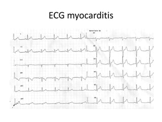ECG myocarditis
 