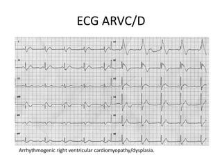 ECG ARVC/D
Arrhythmogenic right ventricular cardiomyopathy/dysplasia.
 