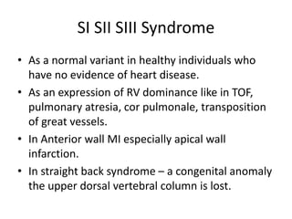 SI SII SIII Syndrome
• As a normal variant in healthy individuals who
have no evidence of heart disease.
• As an expression of RV dominance like in TOF,
pulmonary atresia, cor pulmonale, transposition
of great vessels.
• In Anterior wall MI especially apical wall
infarction.
• In straight back syndrome – a congenital anomaly
the upper dorsal vertebral column is lost.
 