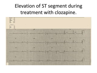 Elevation of ST segment during
treatment with clozapine.
 