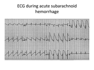 ECG during acute subarachnoid
hemorrhage
 