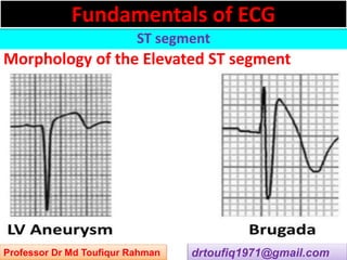 Approach to a patient with ST segment abnormality in ECG | PPSX