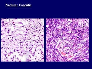 Nodular Fasciitis
 
