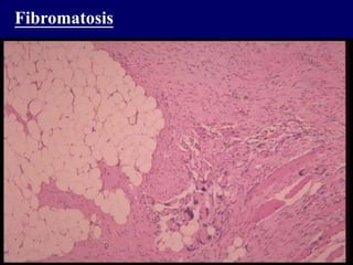 Fibromatosis
 