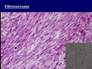 Fibrosarcoma
 