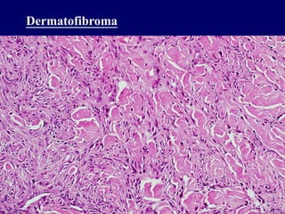 Dermatofibroma
 