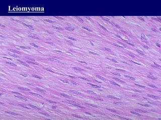 Leiomyoma
 