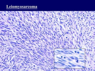 Leiomyosarcoma
 
