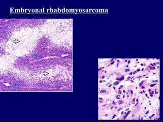 Embryonal rhabdomyosarcoma
 