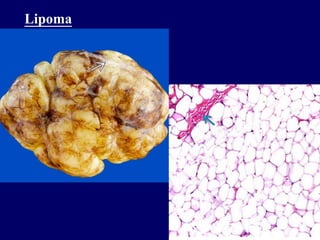Lipoma
 