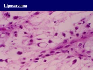 Liposarcoma
 