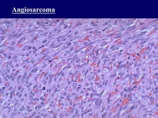 Angiosarcoma
 