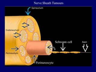 Nerve Sheath Tumours
 
