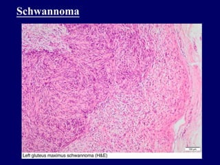 Schwannoma
 