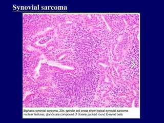Synovial sarcoma
 
