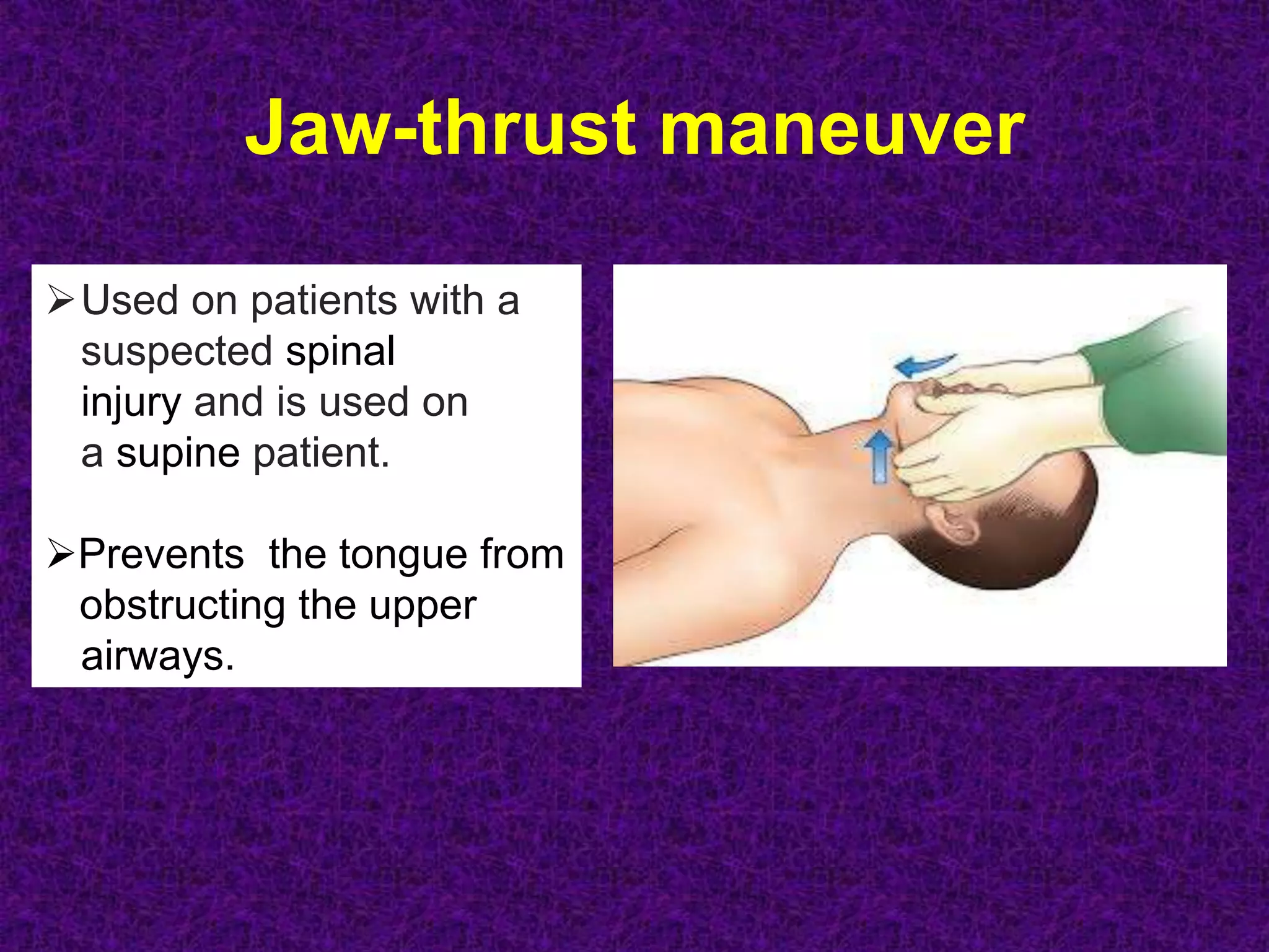 Jaw-thrust maneuver
Used on patients with a
suspected spinal
injury and is used on
a supine patient.
Prevents the tongue from
obstructing the upper
airways.
 