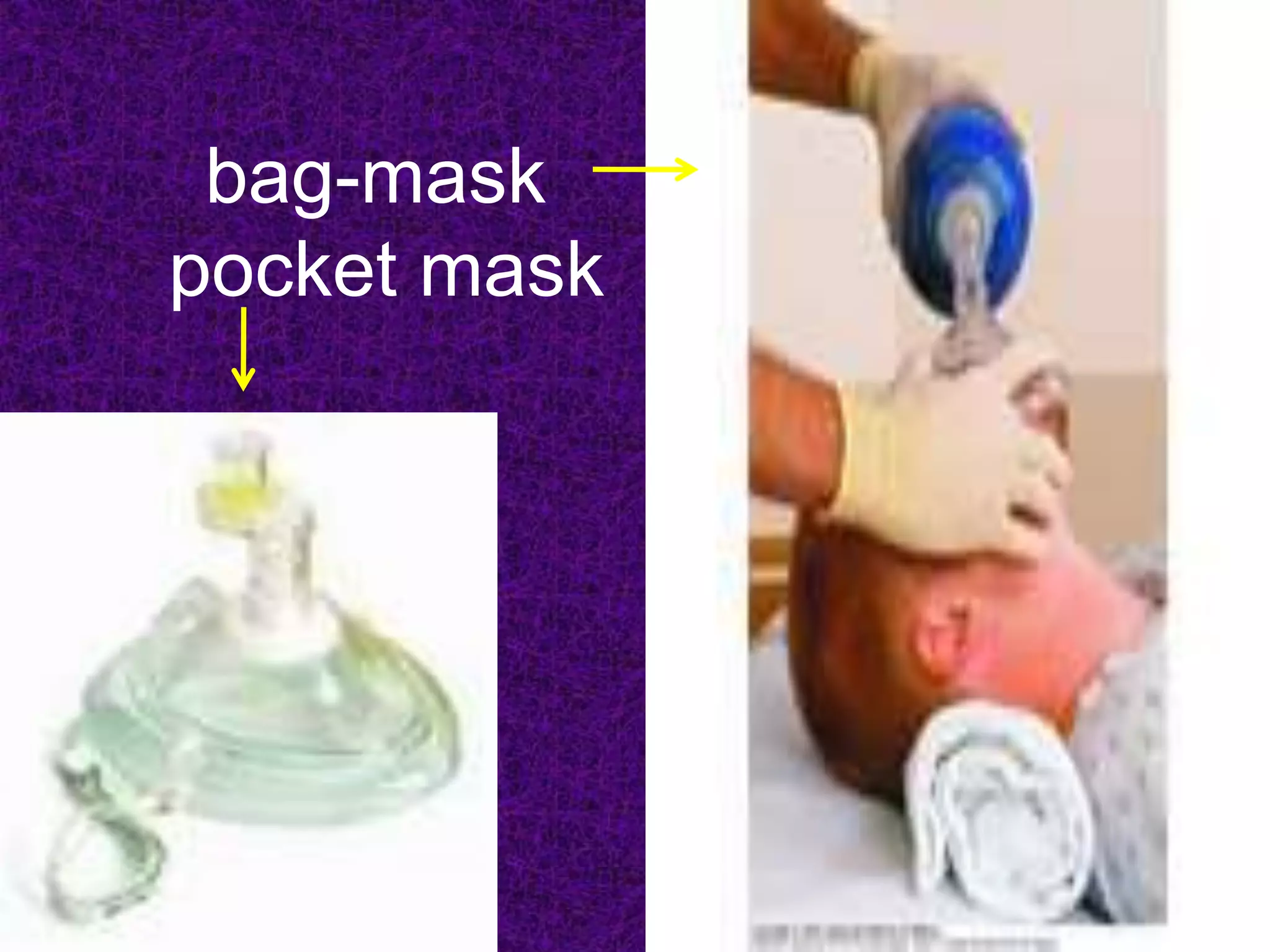 bag-mask
pocket mask
 