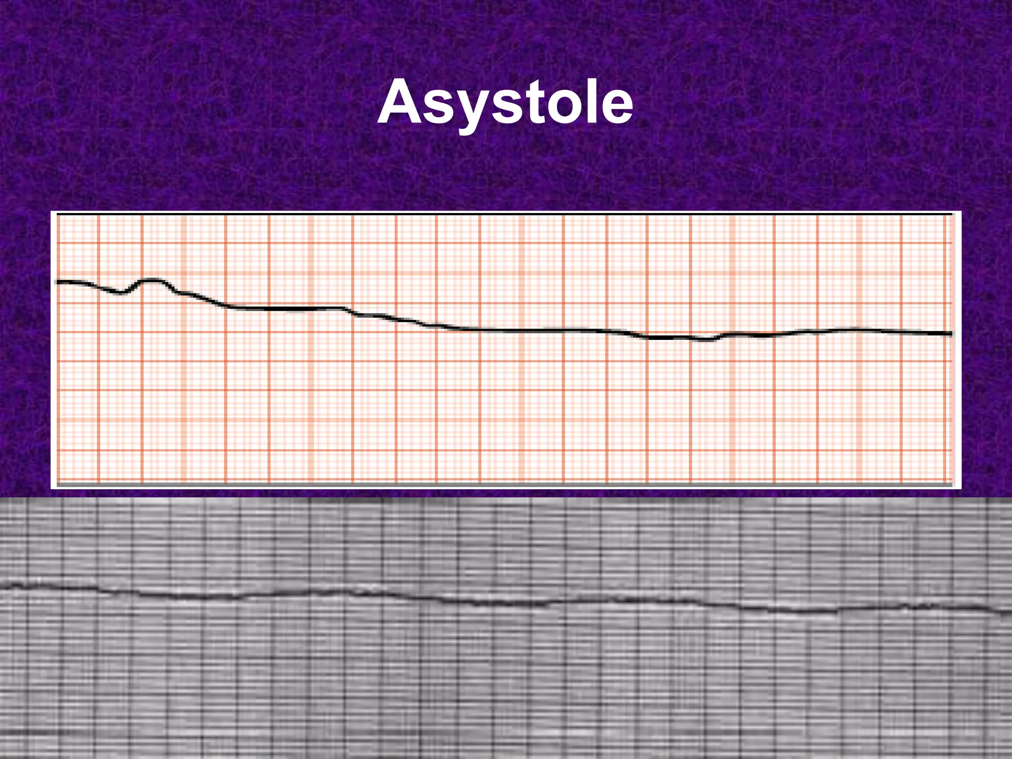 Asystole
 