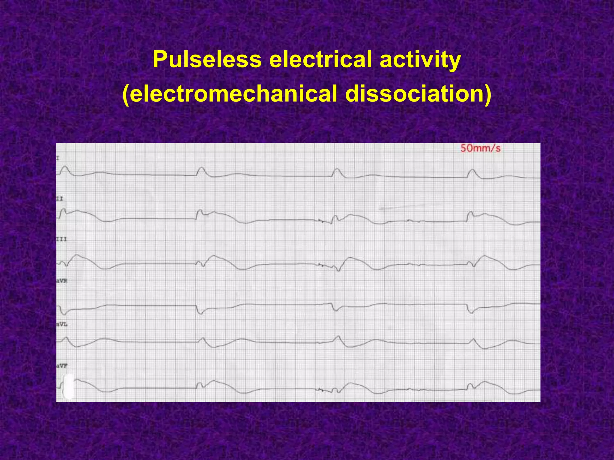 Pulseless electrical activity
(electromechanical dissociation)
 