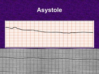 Asystole
 