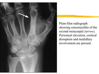 Plain-film radiograph
showing osteomyelitis of the
second metacarpal (arrow).
Periosteal elevation, cortical
disruption and medullary
involvement are present.
 