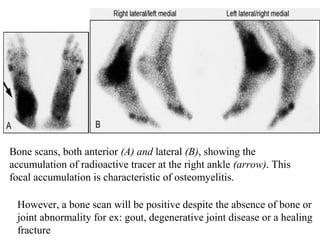 Bone scans, both anterior (A) and lateral (B), showing the
accumulation of radioactive tracer at the right ankle (arrow). This
focal accumulation is characteristic of osteomyelitis.
However, a bone scan will be positive despite the absence of bone or
joint abnormality for ex: gout, degenerative joint disease or a healing
fracture
 