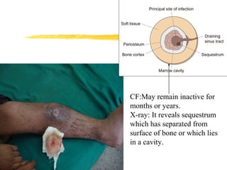 CF:May remain inactive for
months or years.
X-ray: It reveals sequestrum
which has separated from
surface of bone or which lies
in a cavity.
 