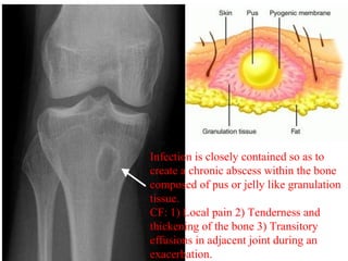 Infection is closely contained so as to
create a chronic abscess within the bone
composed of pus or jelly like granulation
tissue.
CF: 1) Local pain 2) Tenderness and
thickening of the bone 3) Transitory
effusions in adjacent joint during an
exacerbation.
 