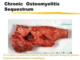 Chronic Osteomyelitis
Sequestrum
It is a piece of dead bone that has become separated during the process
of necrosis from normal or sound bone.
 