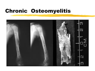 Chronic Osteomyelitis
 