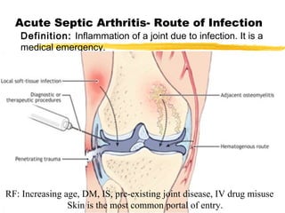 Acute Septic Arthritis- Route of Infection
Definition: Inflammation of a joint due to infection. It is a
medical emergency.
RF: Increasing age, DM, IS, pre-existing joint disease, IV drug misuse
Skin is the most common portal of entry.
 