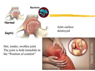 Joint surface
destroyed
Hot, tender, swollen joint
The joint is held immobile in
the “Position of comfort”
 