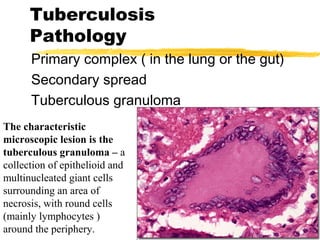 Tuberculosis
Pathology
Primary complex ( in the lung or the gut)
Secondary spread
Tuberculous granuloma
The characteristic
microscopic lesion is the
tuberculous granuloma – a
collection of epithelioid and
multinucleated giant cells
surrounding an area of
necrosis, with round cells
(mainly lymphocytes )
around the periphery.
 