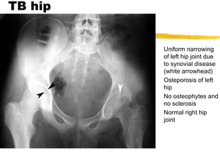 TB hip
Uniform narrowing
of left hip joint due
to synovial disease
(white arrowhead)
Osteporosis of left
hip
No osteophytes and
no sclerosis
Normal right hip
joint
 