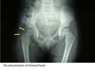 De-structuration of femoral head
 