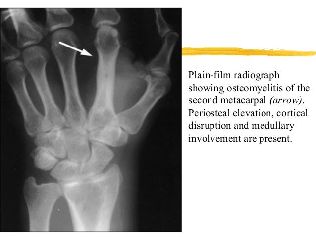 Bone and joint infections- Osteomyelitis