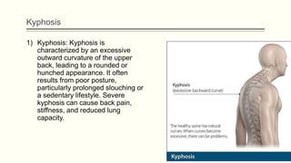 Kyphosis
1) Kyphosis: Kyphosis is
characterized by an excessive
outward curvature of the upper
back, leading to a rounded or
hunched appearance. It often
results from poor posture,
particularly prolonged slouching or
a sedentary lifestyle. Severe
kyphosis can cause back pain,
stiffness, and reduced lung
capacity.
 
