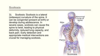 Scoliosis
3). Scoliosis: Scoliosis is a lateral
(sideways) curvature of the spine. It
can be congenital (present at birth) or
develop during adolescence. In
severe cases, scoliosis can cause the
spine to twist, leading to physical
deformity, reduced lung capacity, and
back pain. Early detection and
appropriate medical interventions are
crucial for managing scoliosis.
 