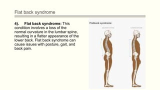 Flat back syndrome
4). Flat back syndrome: This
condition involves a loss of the
normal curvature in the lumbar spine,
resulting in a flatter appearance of the
lower back. Flat back syndrome can
cause issues with posture, gait, and
back pain.
 