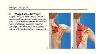 Winged scapula
6). Winged scapula: Winged
scapula occurs when the shoulder
blades protrude prominently from the
back. It can result from weak shoulder
blade stabilizing muscles or nerve
damage. This condition may cause
pain and limited shoulder movement.
 